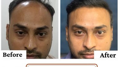 Photo of 5 Surprises That Experts of Hair Transplant In Delhi