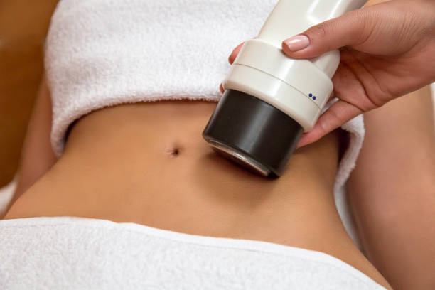 coolsculpting procedure