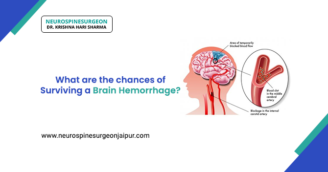 What are the chances of surviving a Brain Hemorrhage