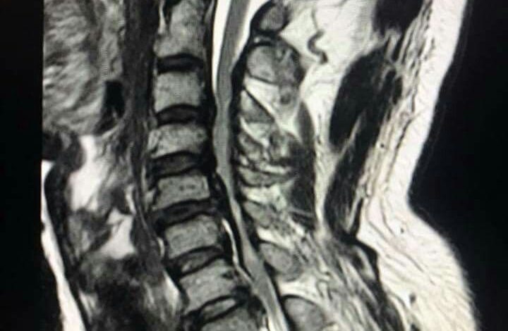 disc osteophyte complex