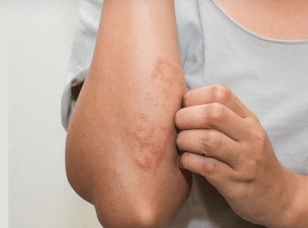 eczema ayurvedic treatment