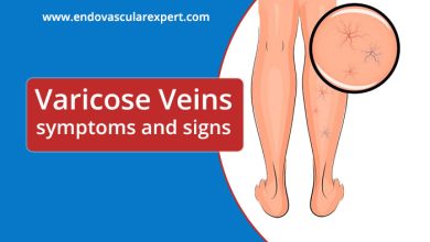 Photo of What are varicose veins and their signs & symptoms?