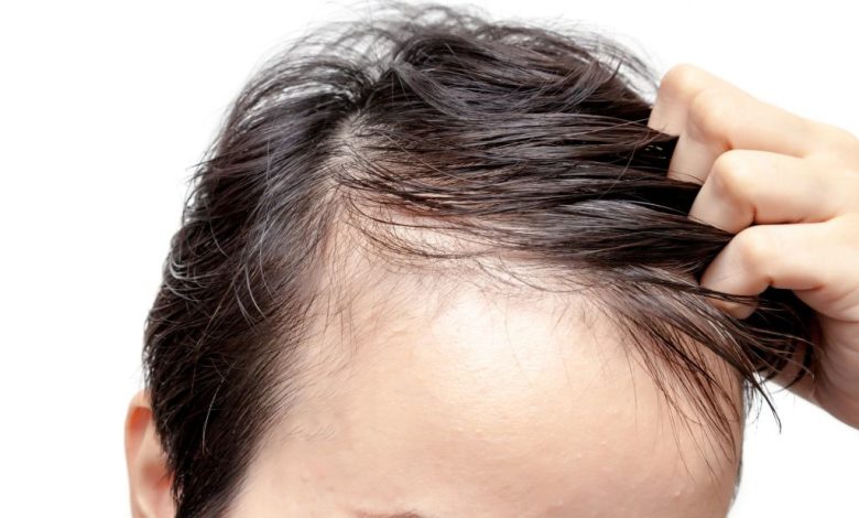 Hair Loss Medication for Men