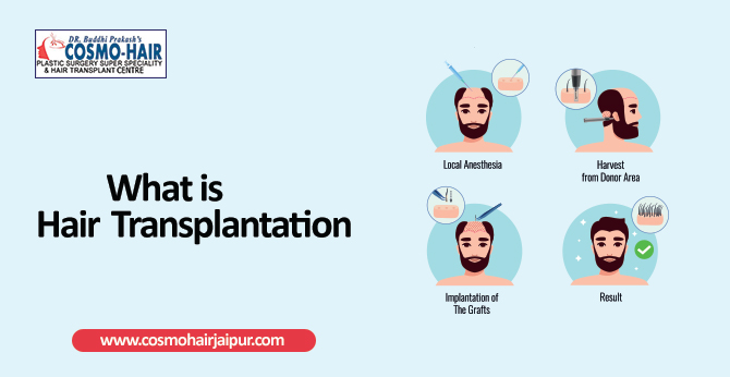 What is hair transplantation