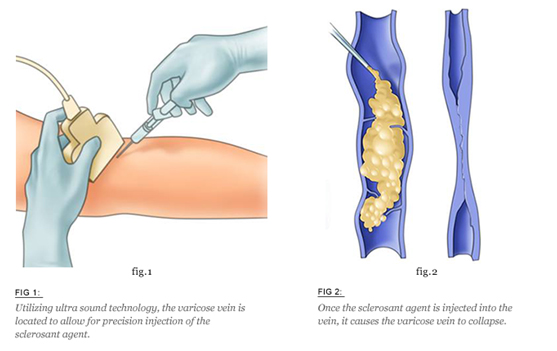 Sclerotherapy for varicose vein treatment