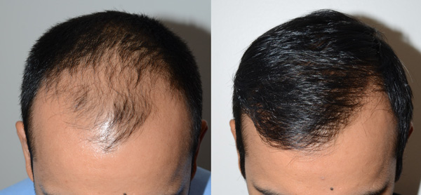 hair transplant