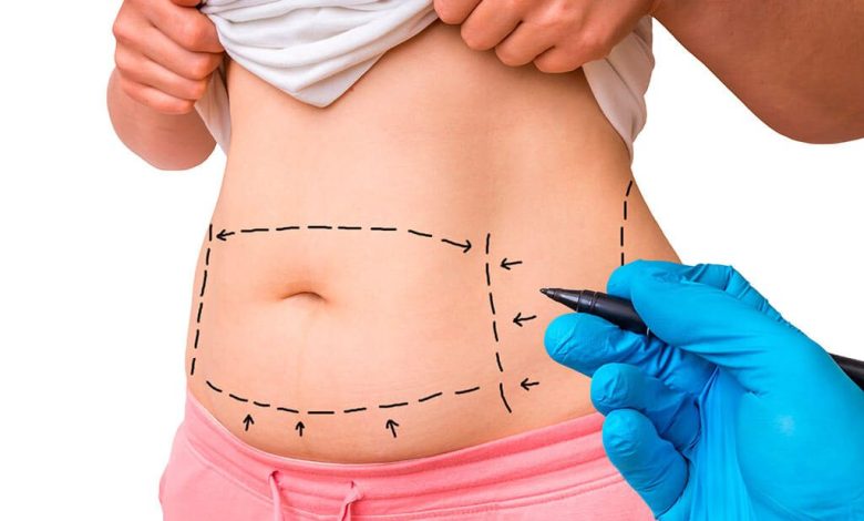 tummy tuck