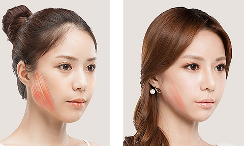 Jaw Botox in Singapore