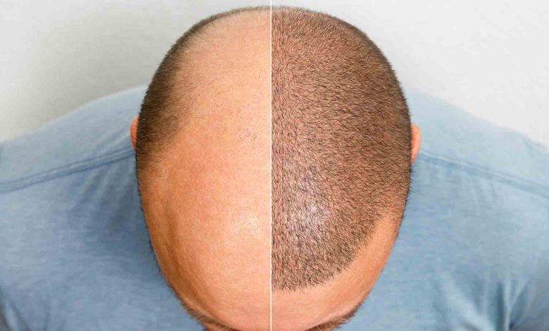 hair loss recovery program